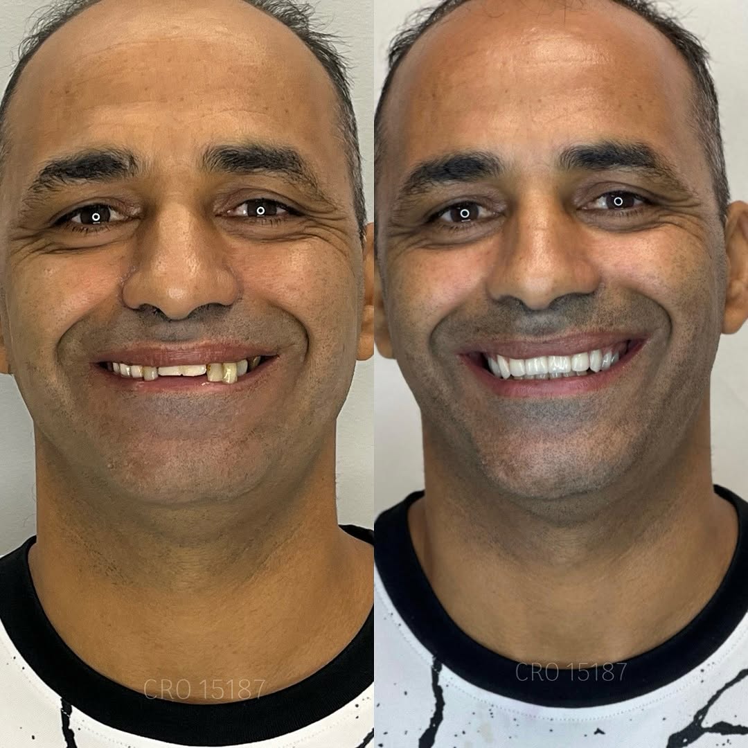 Transformação de Sorriso 1