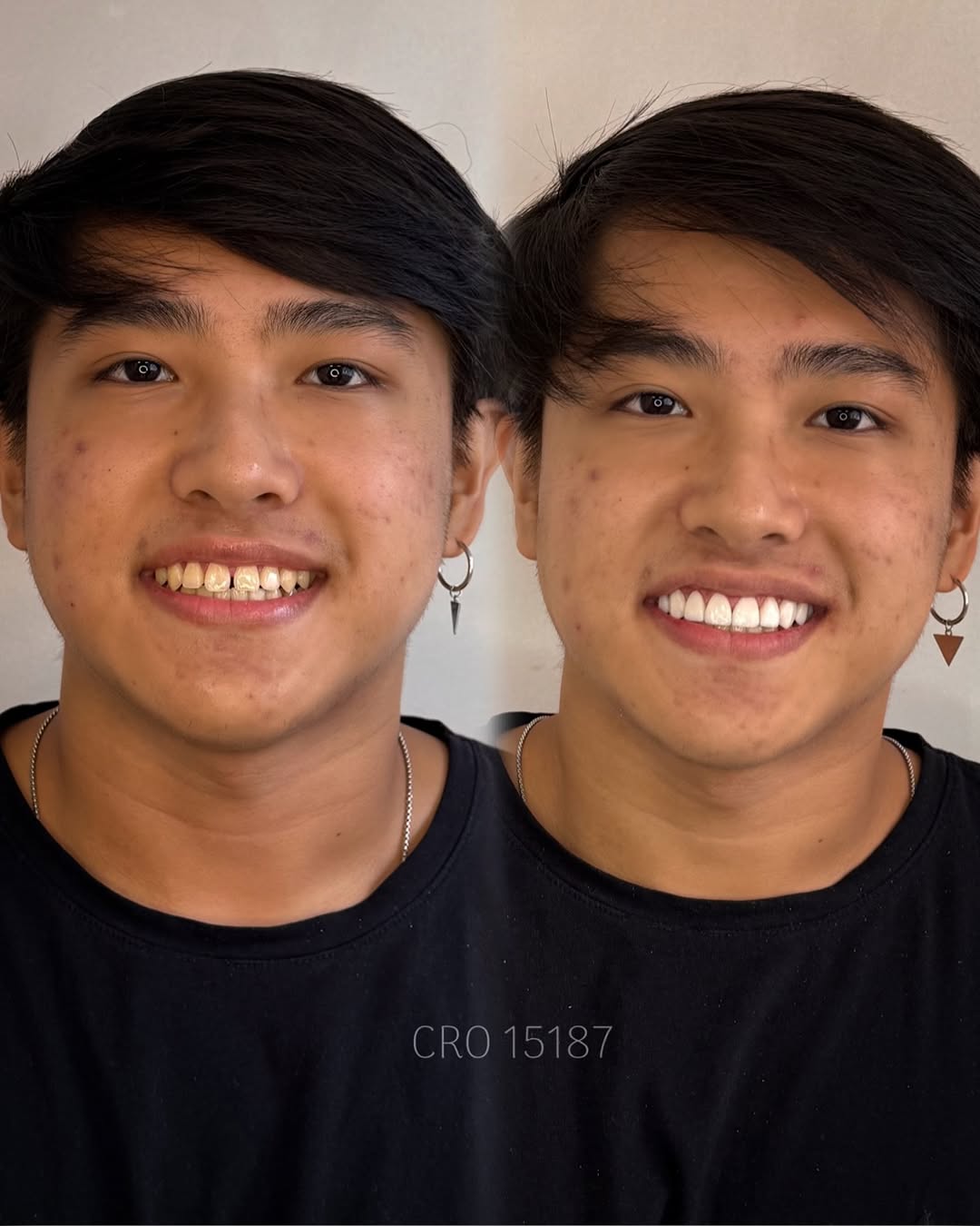 Transformação de Sorriso 2