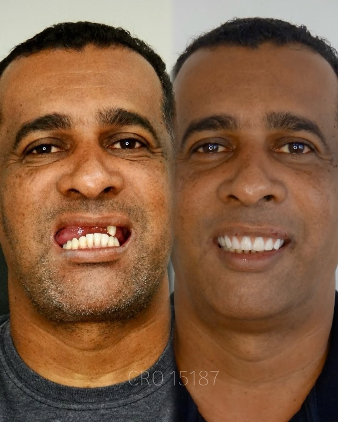 Transformação de Sorriso 3