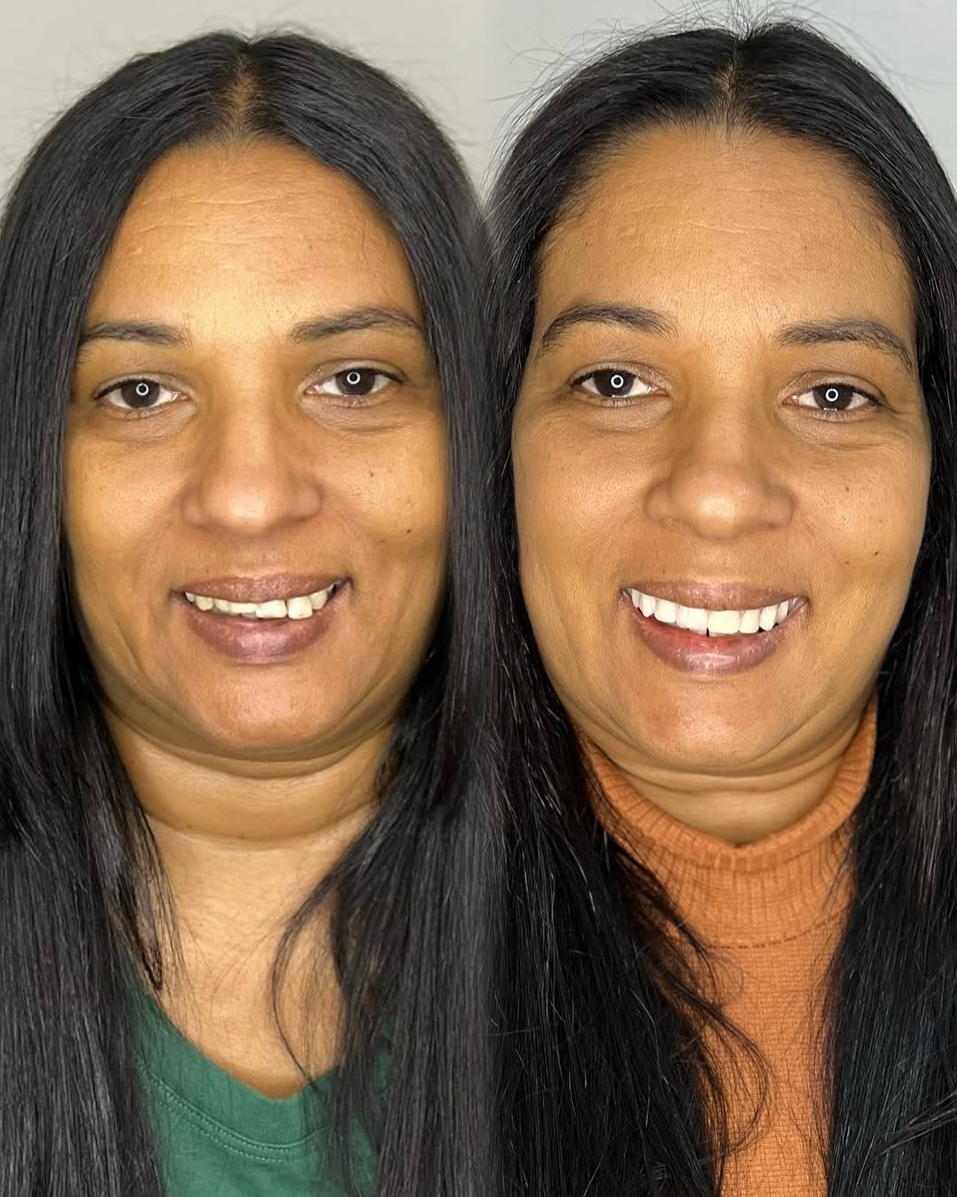 Transformação de Sorriso 4