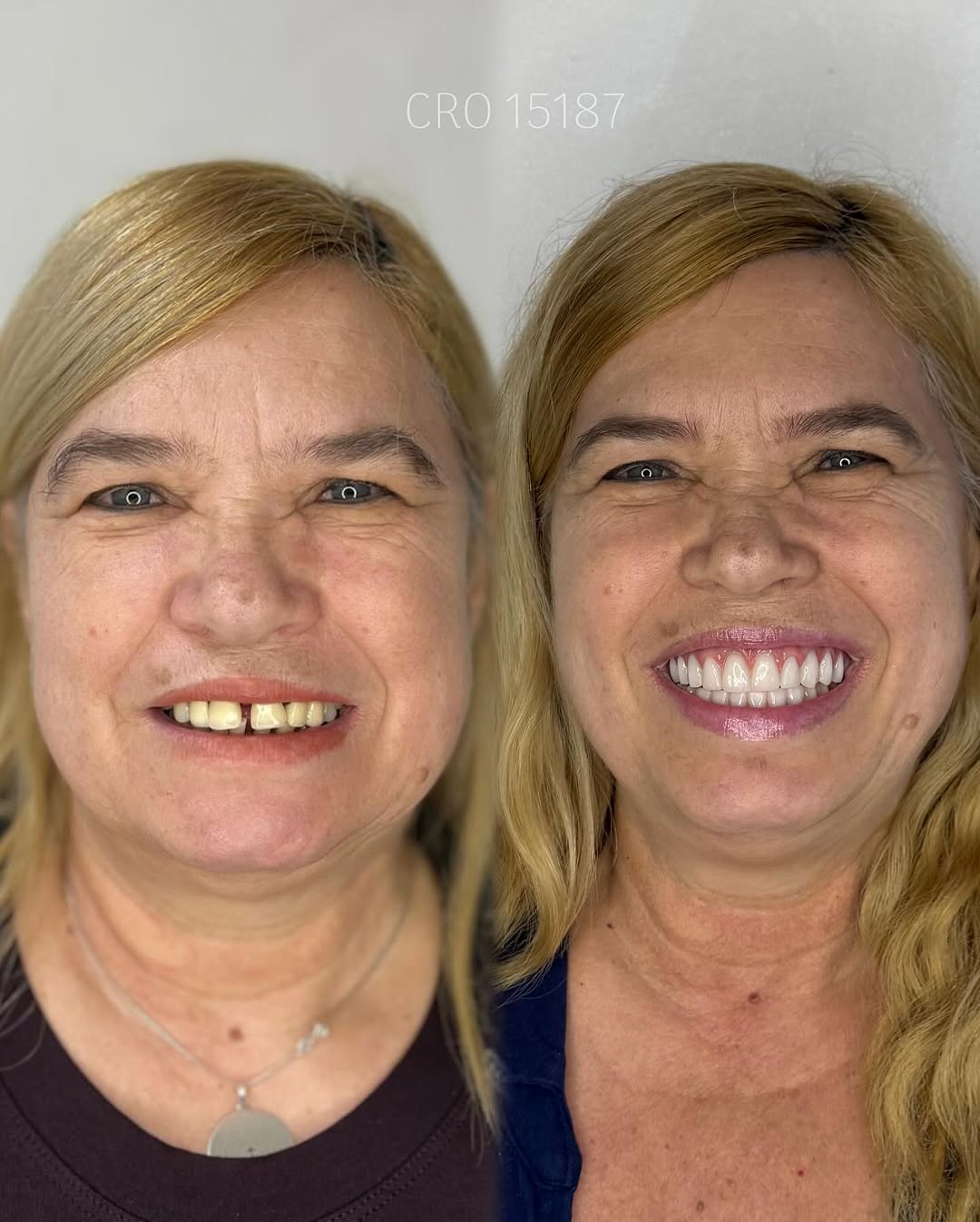 Transformação de Sorriso 6