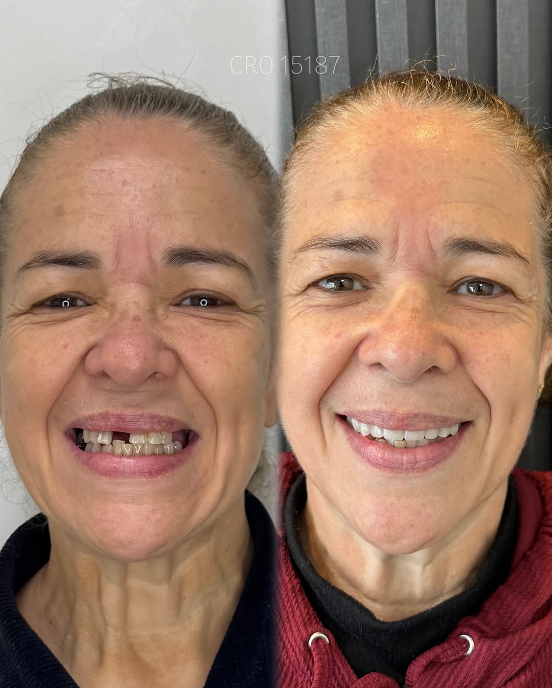 Transformação de Sorriso 7